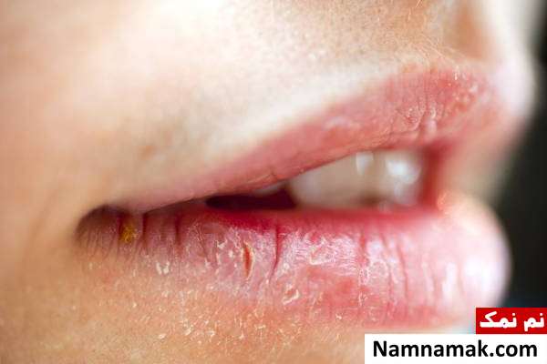 علت ترک خوردن گوشه لب 