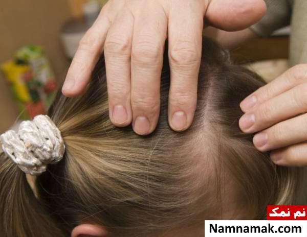 رشک مو چیست و درمان خانگی آن کدام است؟ نحوه درمان خانگی رشک مو