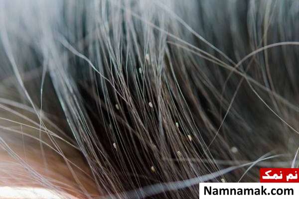 نشانه­ های آلودگی به شپش سر 