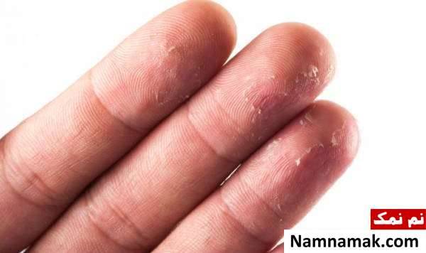 پوسته شدن انگشتان دست نشانه چیست؟