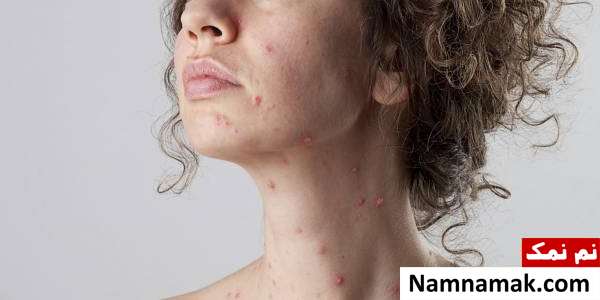 عوارض آبله مرغان