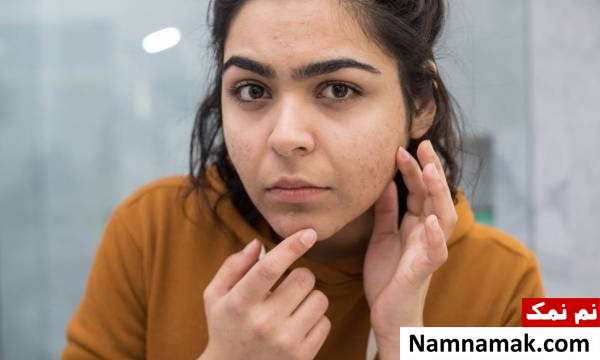 رفع آکنه چانه ترفندهای رفع سریع آکنه چانه