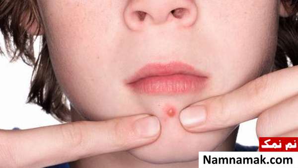 دلیل آکنه آلات موسیقی مرتبط با چانه