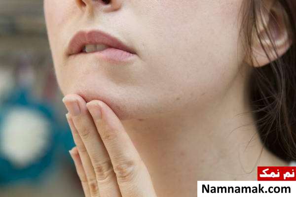 علت جوش چونه جوش روی چانه نشانه چیه