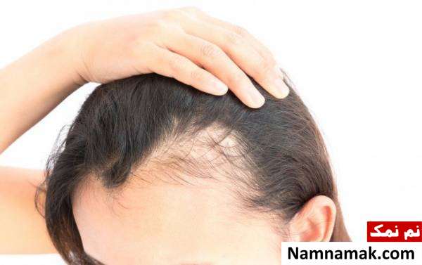 آویشن برای درمان ریزش مو 