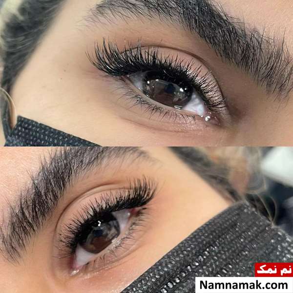 کاشت مژه به روش جراحی