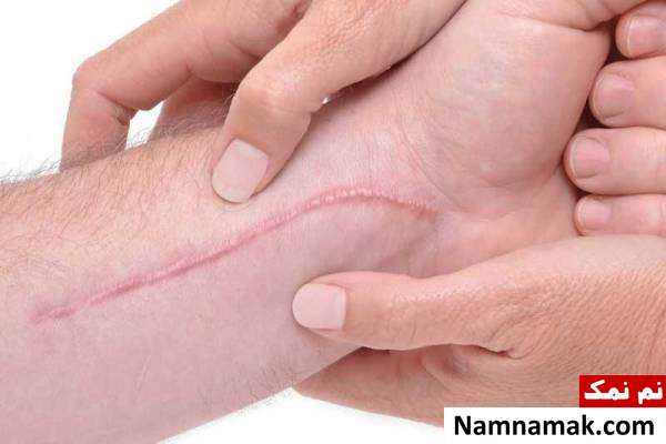 جای زخم کلوئید رفع جای زخم و بخیه