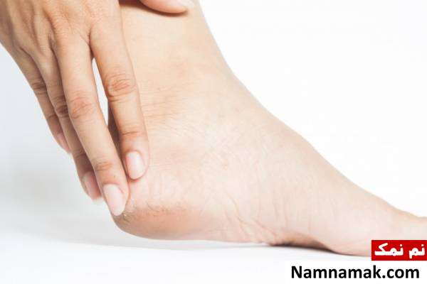 پا در دیابت عوارض دیابت روی پا
