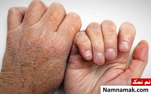 دلایل جذام علامت های جذام