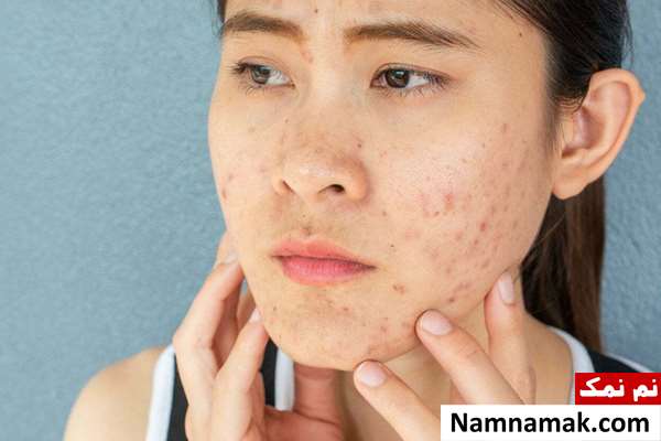 چه چیزی آکنه را بدتر می کند؟