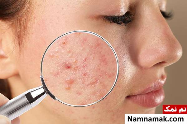 چه چیزی آکنه را بدتر می کند؟