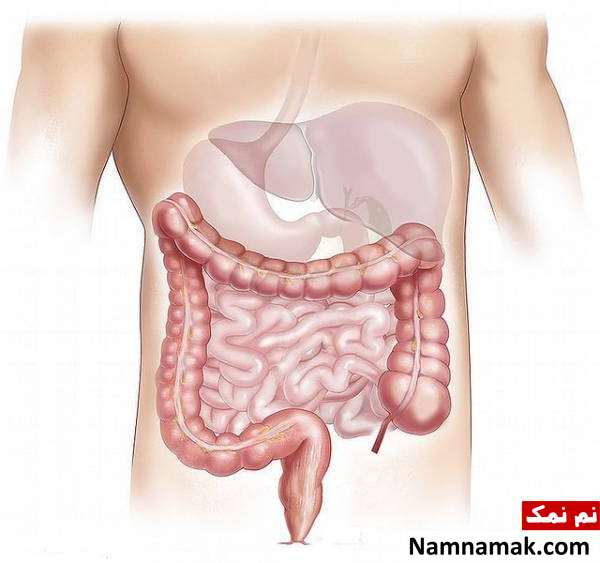 عوارض کرون روده