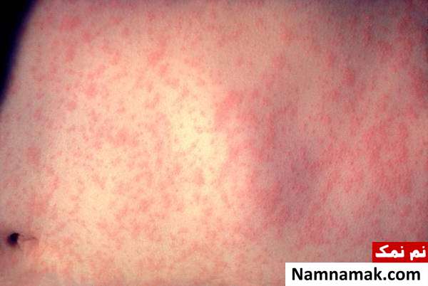 گرفتگی عضلات نشانه چیست؟