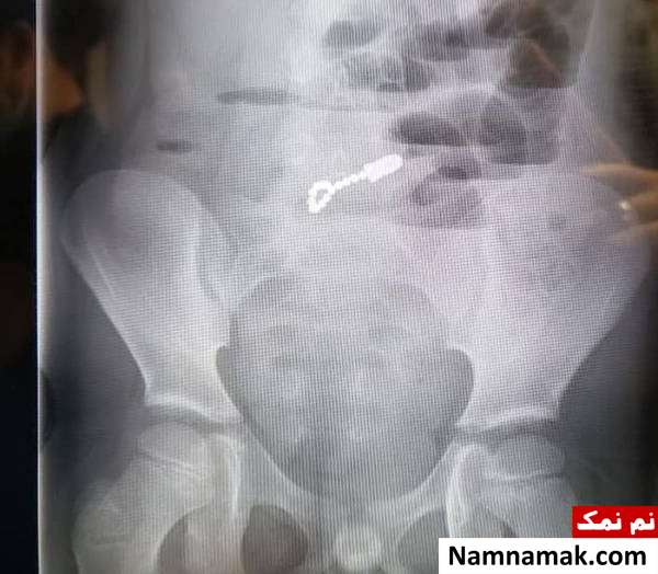 سوراخ شدن روده کودک جراحی روده کودک 6 ساله