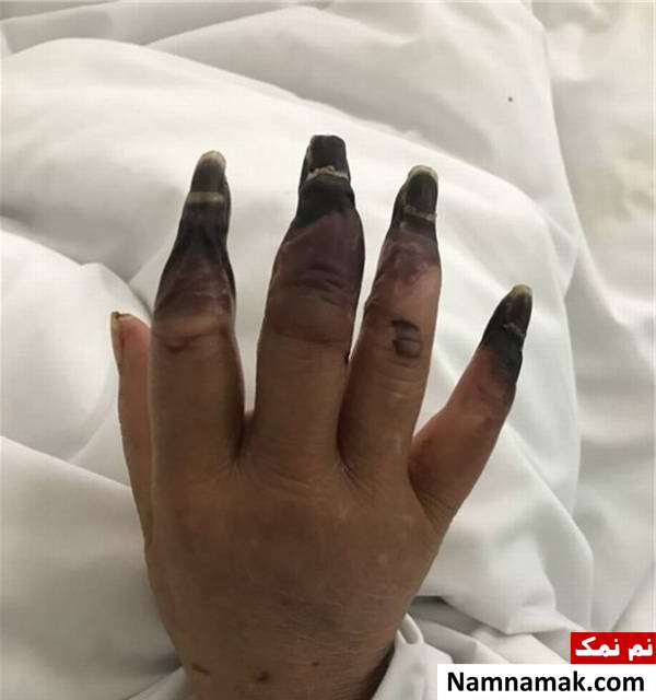 زنی که انگشت هایش خورده شد!! زنی که برای انگشت هایش اتفاق عجیب افتاد