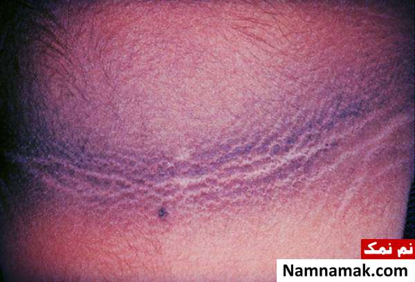 acanthosis nigricans بیماری acanthosis nigricans