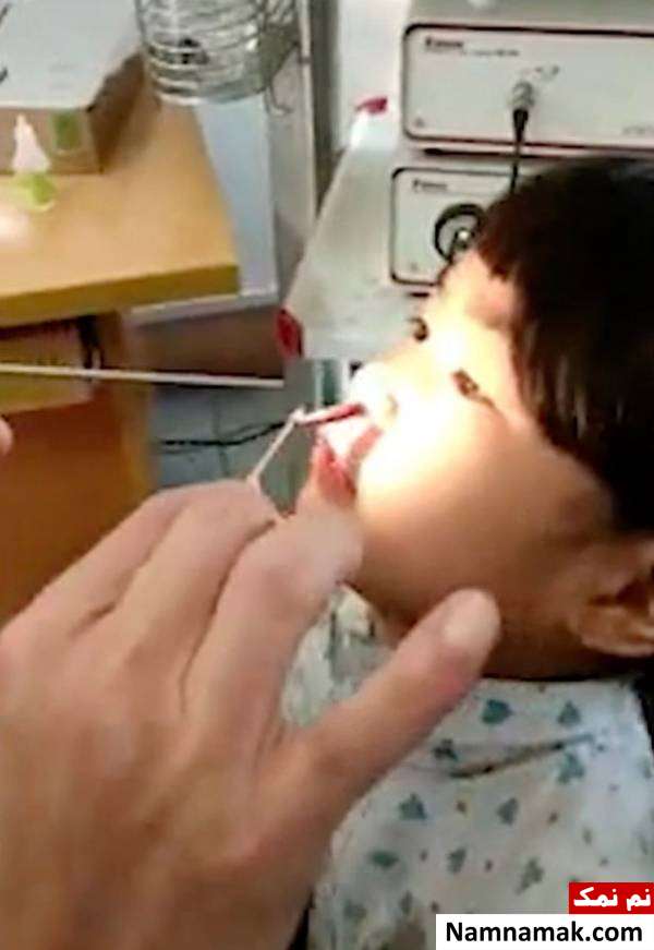 بیرون آمدن کرم از بینی دختربچه شش ساله