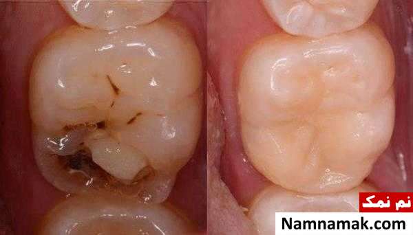 علائم و نشانه های پوسیدگی دندان