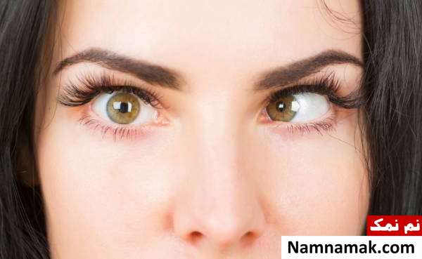 انحراف چشم یا استرابیسم چشم های کج