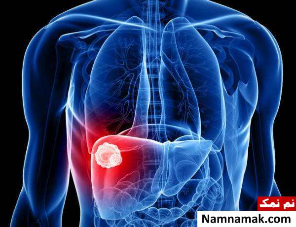 هپاتیت راههای پیشگیری از سیروز کبدی
