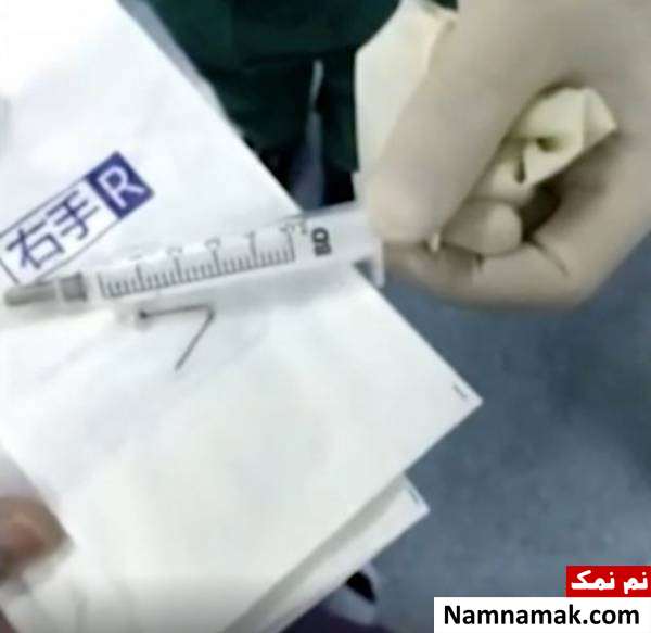 عملیات خارج کردن میخ از ریه های کودک 9 ماهه