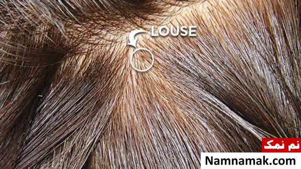 شپش به سراغ چه کسانی میرود؟ 