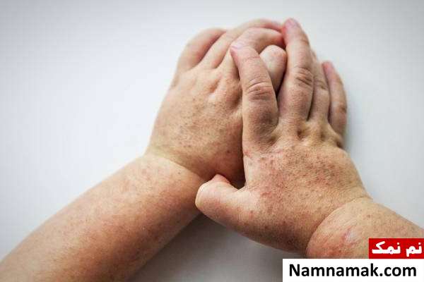 علائم مخملک در کودکان مخملک یا تب سرخ