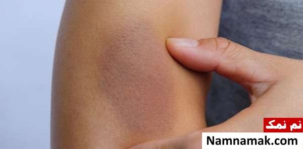 علائم و نشانه های کمبود ویتامین C در بدن