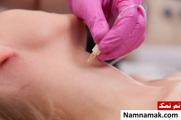 کربوکسی تراپی جای زخم و اسکار