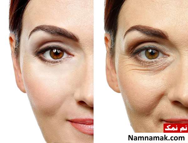 عوارض کربوکسی تراپی دور چشم