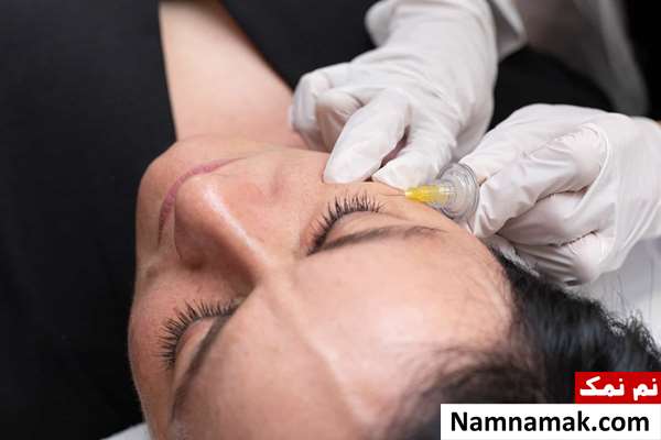 عوارض کربوکسی تراپی دور چشم