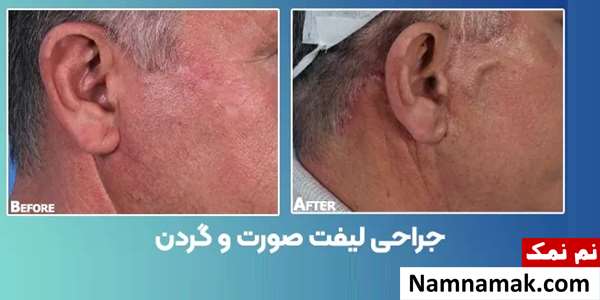جراحی لیفت صورت و گردن
