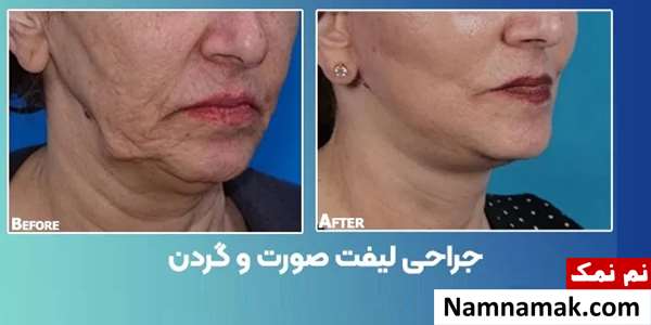 جراحی لیفت صورت و گردن