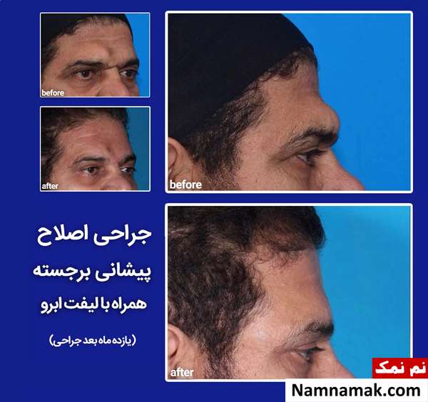 جراحی پیشانی برجسته