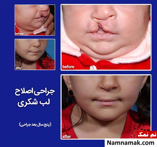 جراحی اصلاح لب شکری