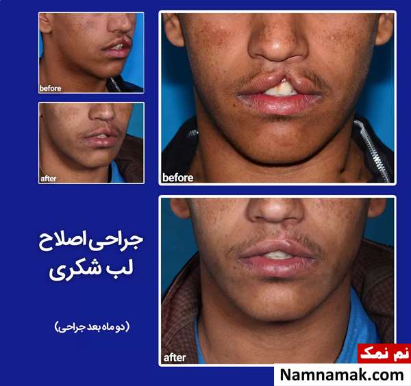 جراحی اصلاح لب شکری