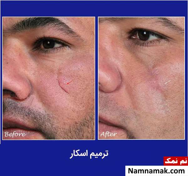 جراحی ترمیم اسکار