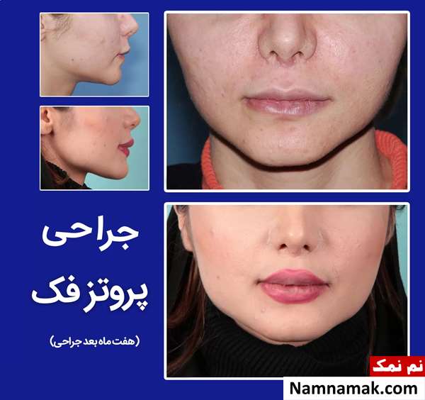 پروتز فک چانه و گونه