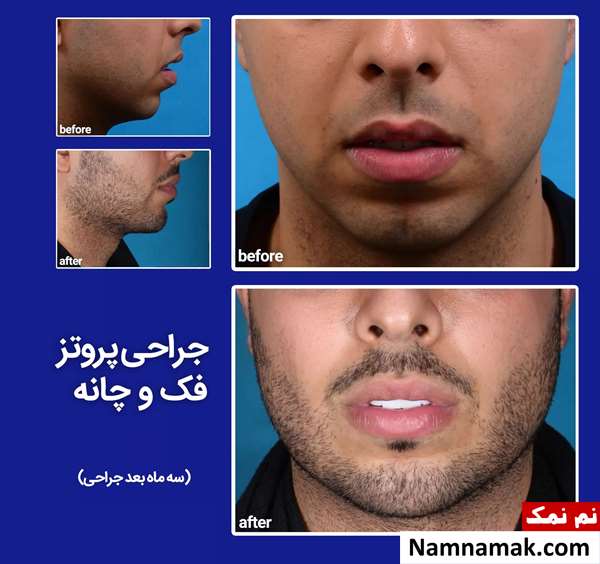 پروتز فک چانه و گونه
