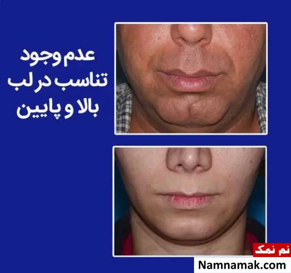 جراحی زیبایی لب