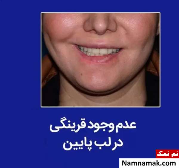 جراحی زیبایی لب