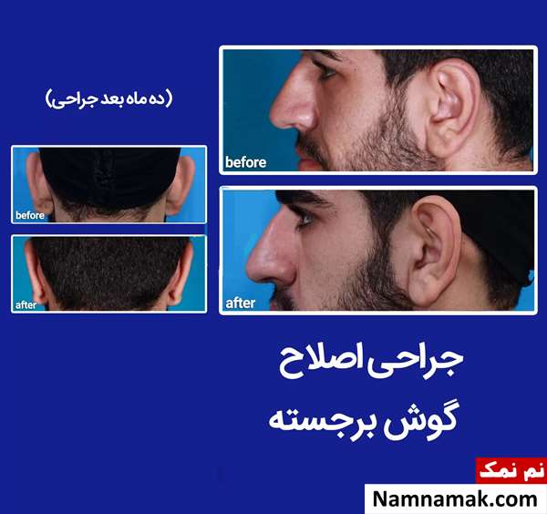 جراحی زیبایی گوش