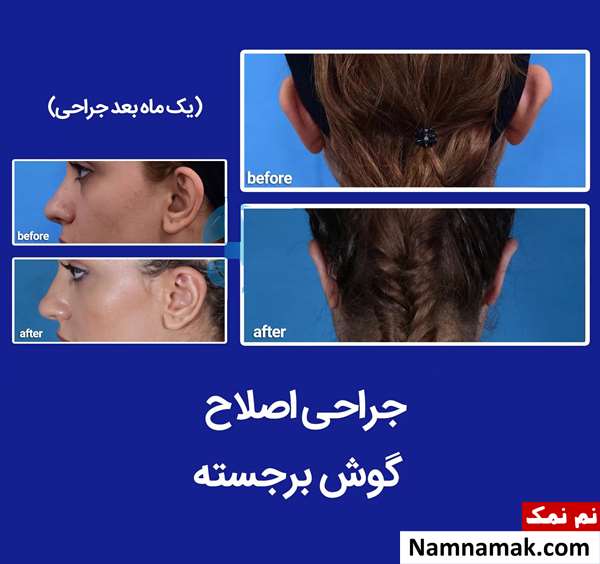 جراحی زیبایی گوش