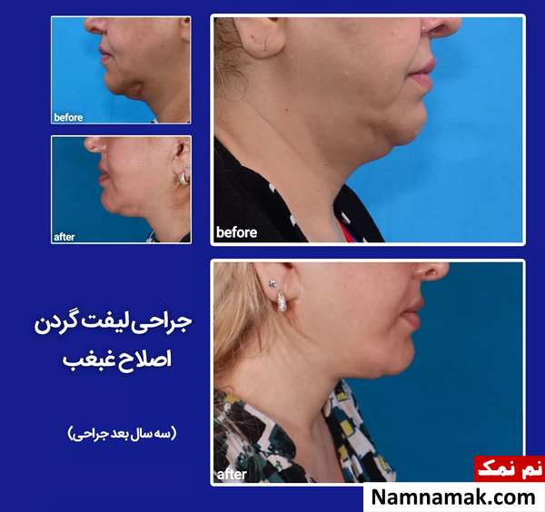 اصلاح و رفع غبغب