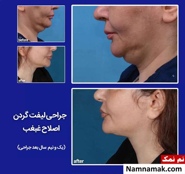 اصلاح و رفع غبغب