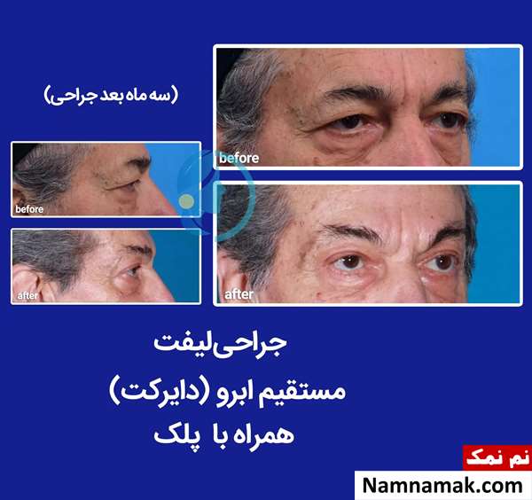لیفت دایرکت ابرو