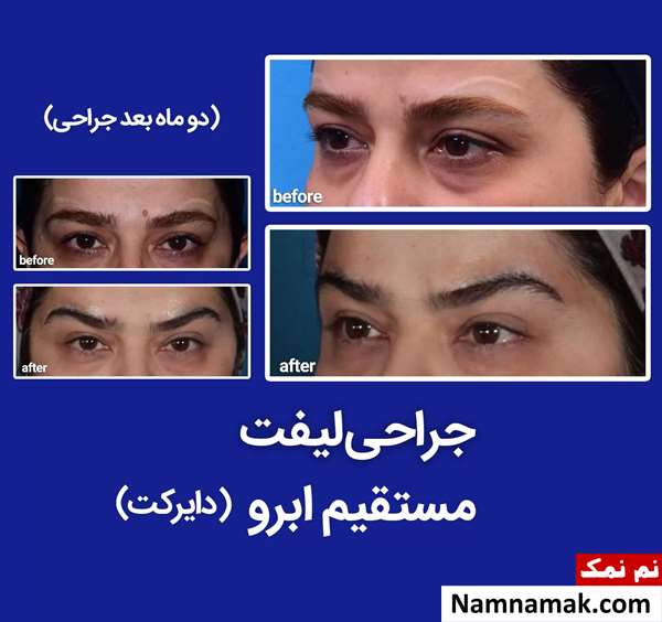 لیفت دایرکت ابرو