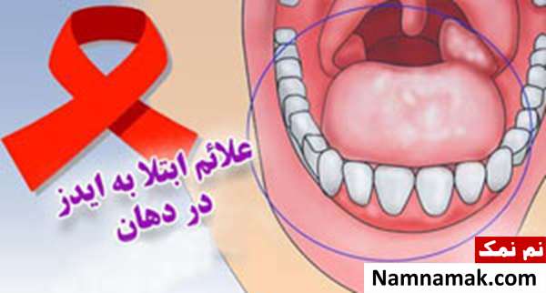 علائم ایدز   در دهان