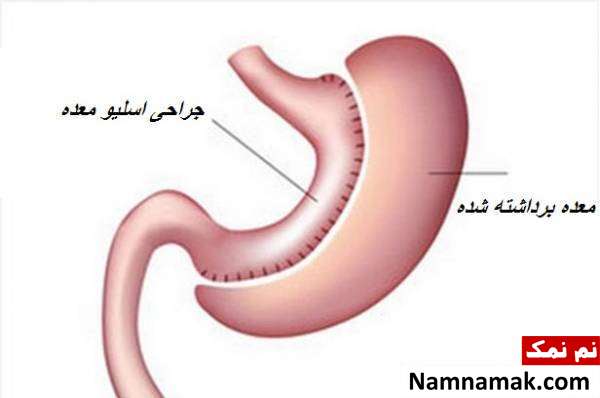 کوچک کردن معده جراحی معده