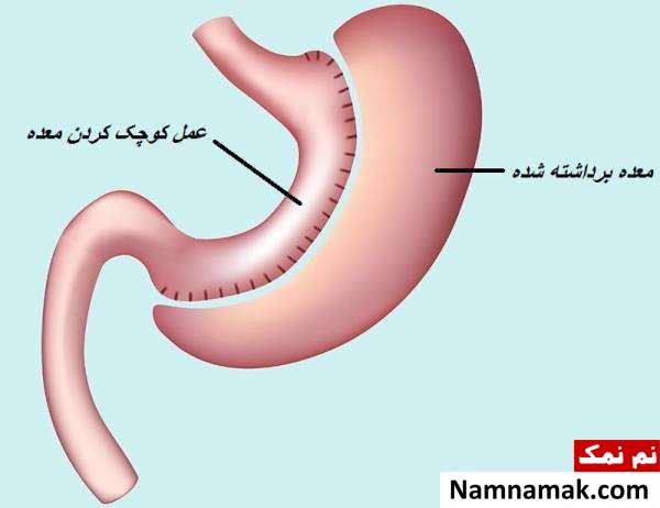 سوالات اسلیو معده سوال درباره اسلیو معده